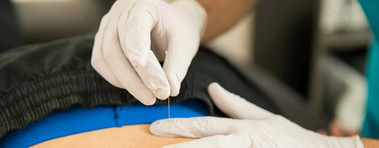 Dry Needling treatment in Edmonton